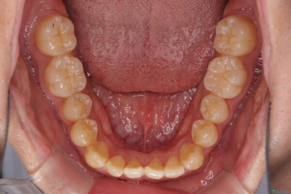 下顎前歯と上顎の部分矯正の適用例 アフター