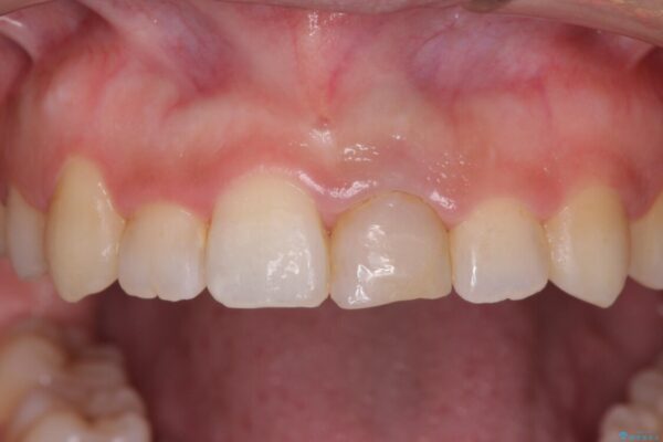 前歯のクロスバイトと変色をワイヤー矯正とセラミック治療で改善 治療前画像