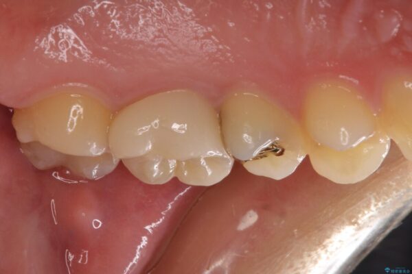 目立つ銀歯を治したい　奥歯のむし歯治療、PGAインレーとオールセラミッククラウン 治療後画像