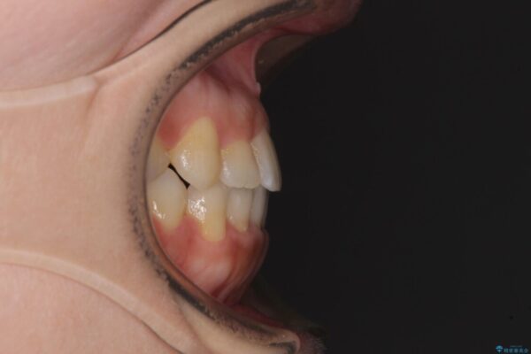 前歯のクロスバイトと変色をワイヤー矯正とセラミック治療で改善 治療後画像