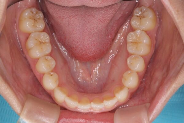 前歯のクロスバイトと変色をワイヤー矯正とセラミック治療で改善 治療後画像