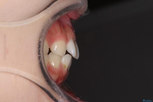 欠損歯と矮小歯　矯正治療と前歯のセラミック治療で理想的な歯列に 治療前画像