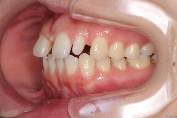 欠損歯と矮小歯　矯正治療と前歯のセラミック治療で理想的な歯列に 治療前画像