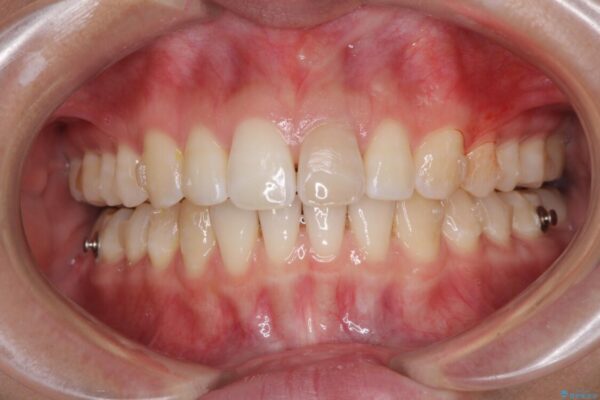 インビザライン矯正とオールセラミッククラウンで気になる前歯の治療 治療途中画像