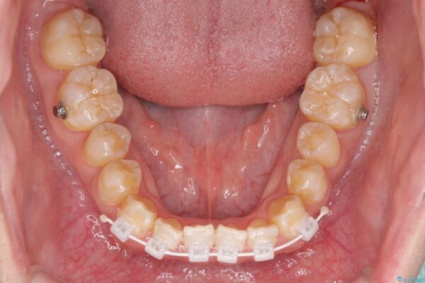 下顎前歯と上顎の部分矯正の適用例 ビフォー