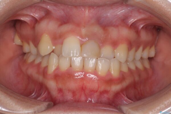 前歯のクロスバイトと変色をワイヤー矯正とセラミック治療で改善 治療前画像