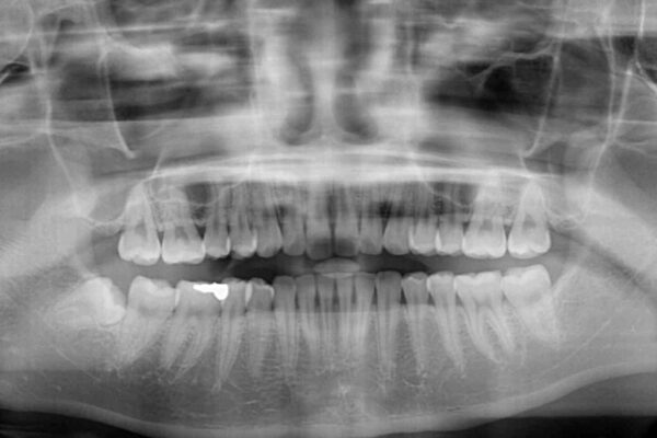 インビザライン矯正とオールセラミッククラウンで気になる前歯の治療 治療前画像