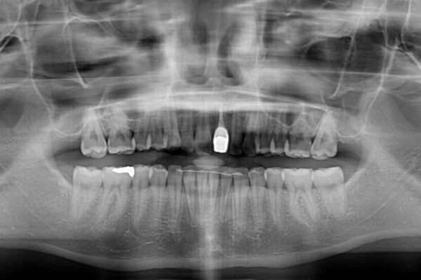 インビザライン矯正とオールセラミッククラウンで気になる前歯の治療 治療後画像