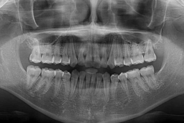 前歯のクロスバイト　メタル装置での矯正治療 治療後画像