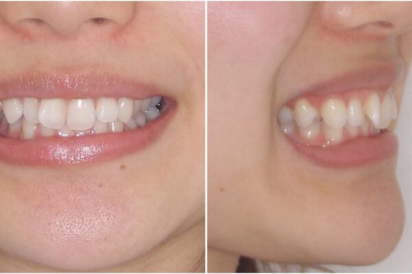 深い咬み合わせと奥歯のむし歯　総合歯科治療 治療前画像