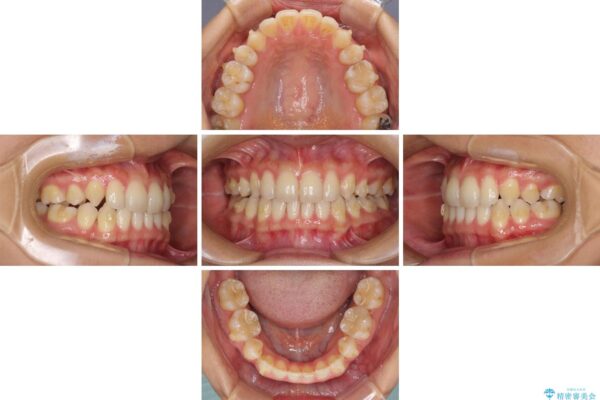 抜歯矯正の後戻りによるすきっ歯をインビザラインで治療 治療途中画像