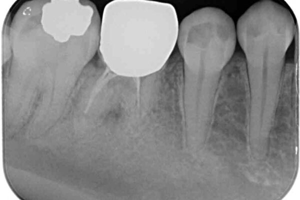 折れてしまった下の奥歯のインプラント治療 治療前画像