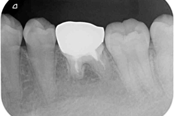 前歯のデコボコを治したい　ワイヤー矯正 治療途中画像
