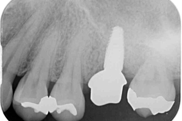 虫歯が進行して抜歯になってしまった奥歯のインプラント治療 治療途中画像