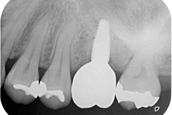 虫歯が進行して抜歯になってしまった奥歯のインプラント治療 治療後画像