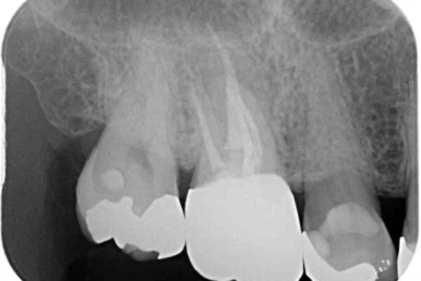 奥歯が痛む　セラミッククラウンによるむし歯治療 治療後画像
