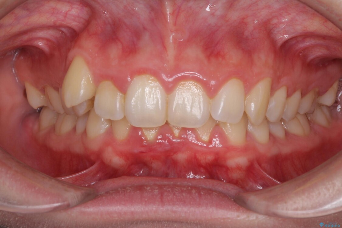 インビザラインと補助装置を用いた抜歯矯正で気になる八重歯を治療 治療前