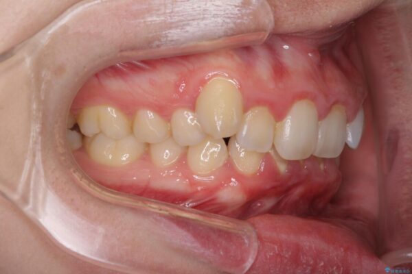 インビザラインと補助装置を用いた抜歯矯正で気になる八重歯を治療 治療前画像
