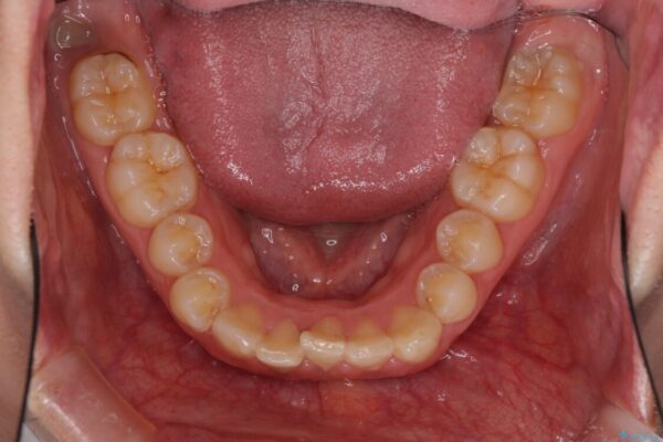 インビザラインと補助装置を用いた抜歯矯正で気になる八重歯を治療 治療前画像