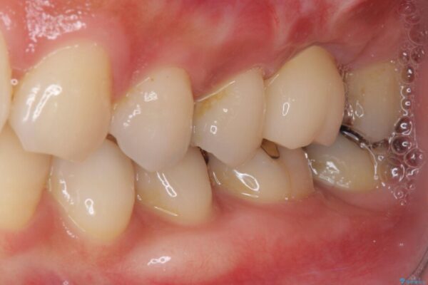 虫歯が進行して抜歯になってしまった奥歯のインプラント治療 治療後画像