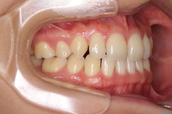 抜歯矯正の後戻りによるすきっ歯をインビザラインで治療 治療前画像