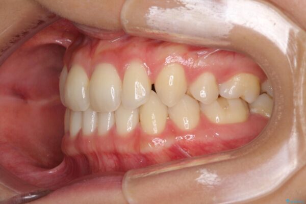抜歯矯正の後戻りによるすきっ歯をインビザラインで治療 治療前画像