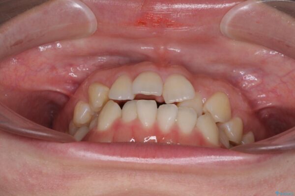 前歯のデコボコを治したい　ワイヤー矯正 治療前画像