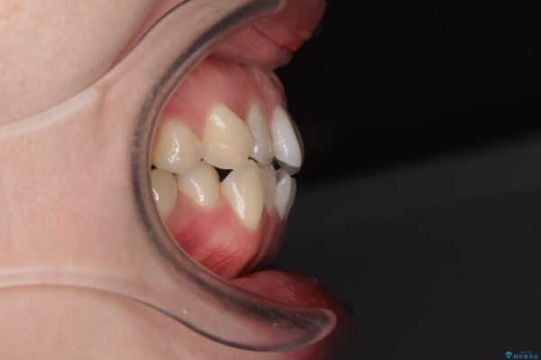 前歯のデコボコを治したい　ワイヤー矯正 治療前画像