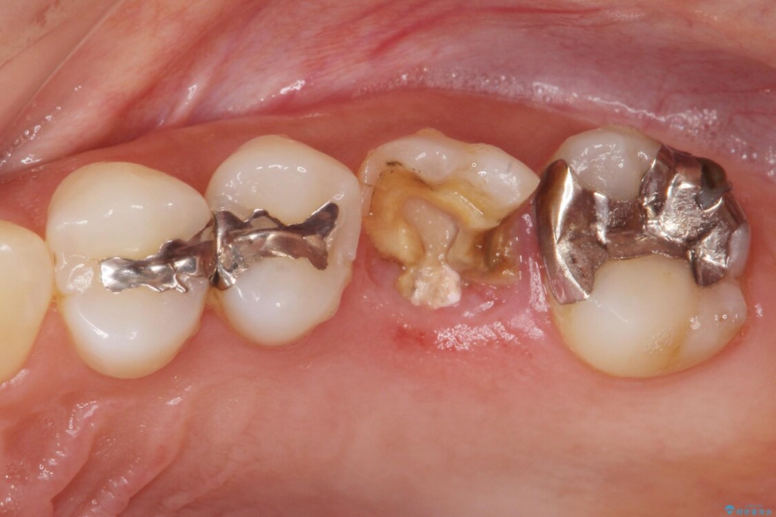 虫歯が進行して抜歯になってしまった奥歯のインプラント治療 治療前