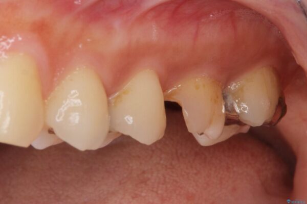 虫歯が進行して抜歯になってしまった奥歯のインプラント治療 治療前画像