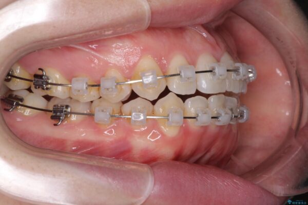 前歯のデコボコを治したい　ワイヤー矯正 治療途中画像