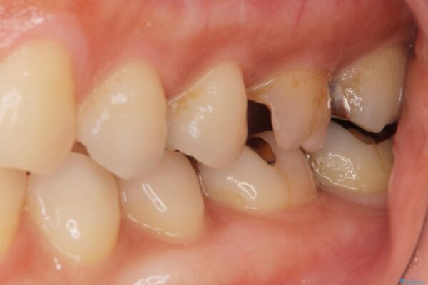 虫歯が進行して抜歯になってしまった奥歯のインプラント治療 治療前画像