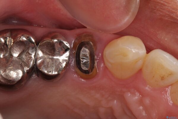 折れてしまった奥歯　インプラントによる補綴治療 治療前画像