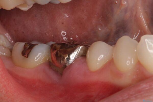 折れてしまった下の奥歯のインプラント治療 治療前画像