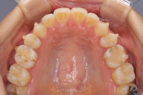 抜歯矯正の後戻りによるすきっ歯をインビザラインで治療 治療途中画像