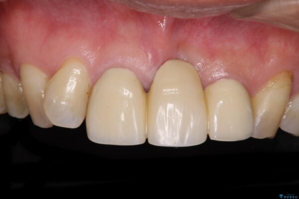 不自然な前歯のブリッジをオールセラミックできれいに 治療前画像