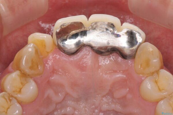 不自然な前歯のブリッジをオールセラミックできれいに 治療前画像