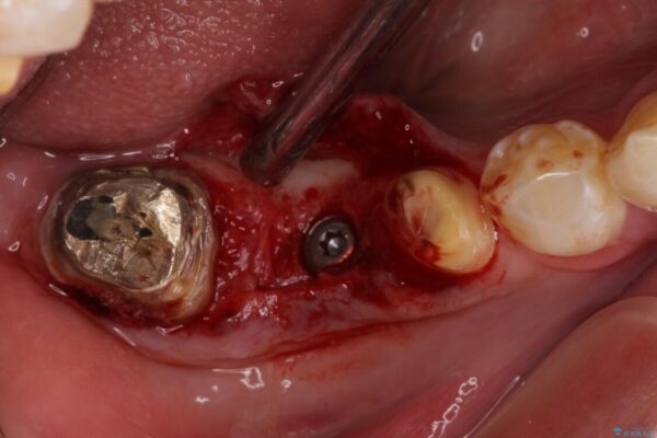 折れてしまった奥歯　インプラントによる補綴治療 治療途中画像