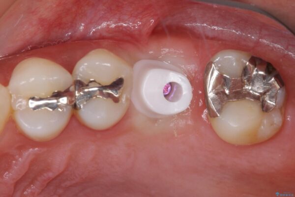 虫歯が進行して抜歯になってしまった奥歯のインプラント治療 治療途中画像