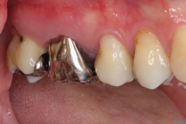 奥歯が痛む　セラミッククラウンによるむし歯治療 治療前画像