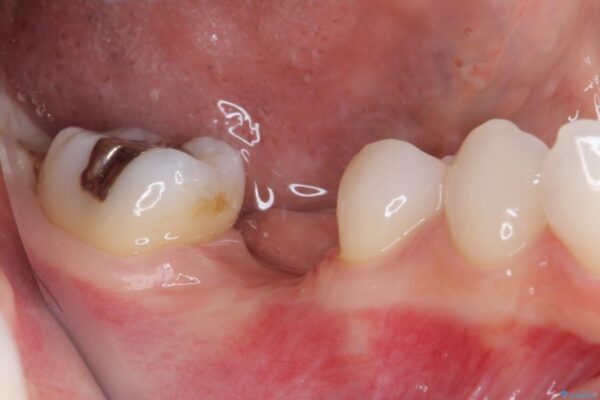 折れてしまった下の奥歯のインプラント治療 治療途中画像