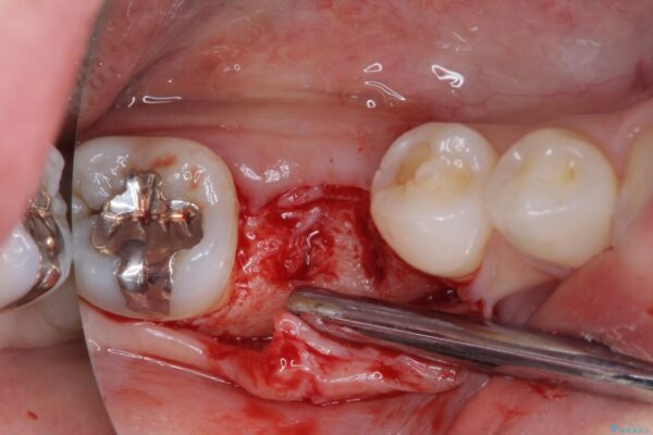 折れてしまった下の奥歯のインプラント治療 治療後画像