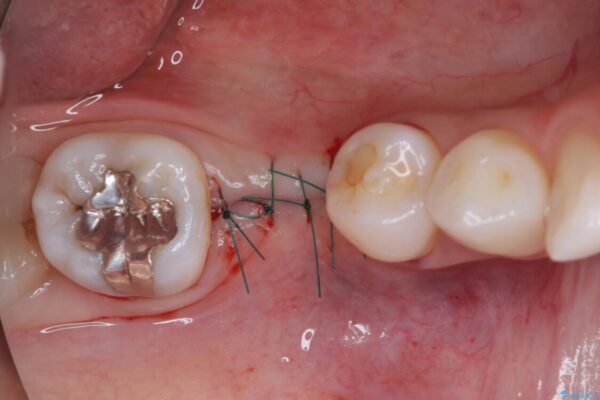 折れてしまった下の奥歯のインプラント治療 治療途中画像