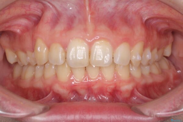 インビザラインと補助装置を用いた抜歯矯正で気になる八重歯を治療 治療途中画像