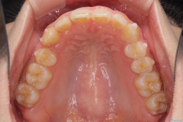 インビザラインと補助装置を用いた抜歯矯正で気になる八重歯を治療 治療途中画像
