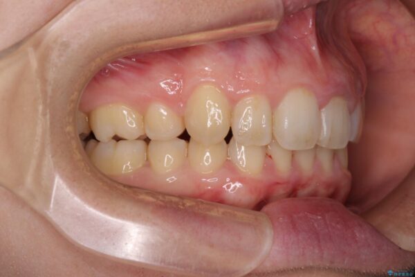 インビザラインと補助装置を用いた抜歯矯正で気になる八重歯を治療 治療後画像