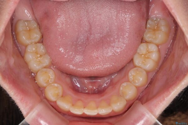 インビザラインと補助装置を用いた抜歯矯正で気になる八重歯を治療 治療後画像