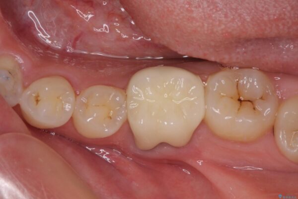 前歯のデコボコを治したい　ワイヤー矯正 治療後画像
