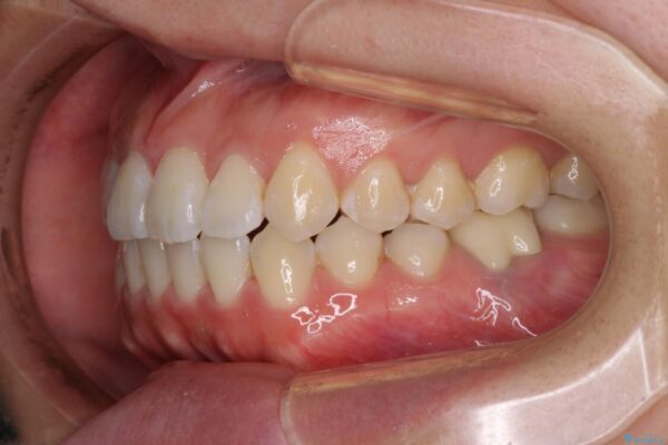 前歯のデコボコを治したい　ワイヤー矯正 治療後画像