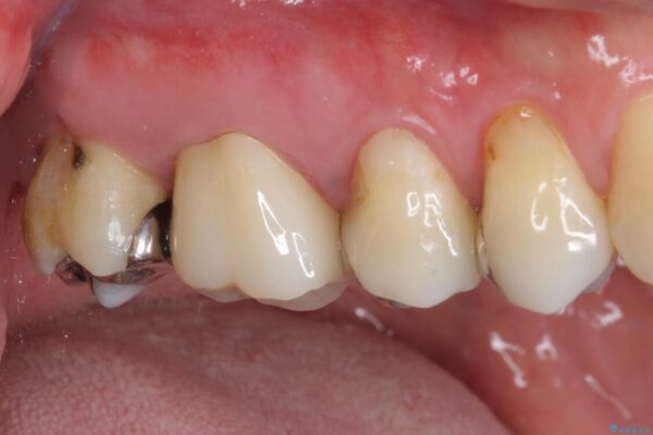 奥歯が痛む　セラミッククラウンによるむし歯治療 治療後画像